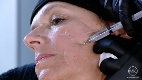 Medical Kongress – Anwendungsvideo Sculptra
